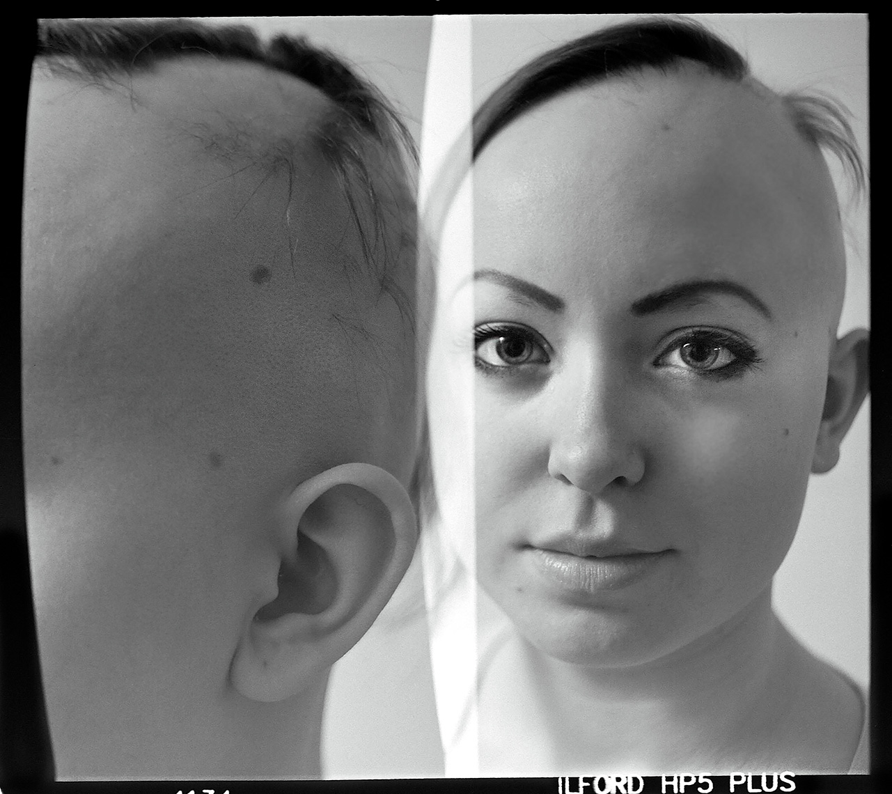 Alopecia Diptych Portrait 4