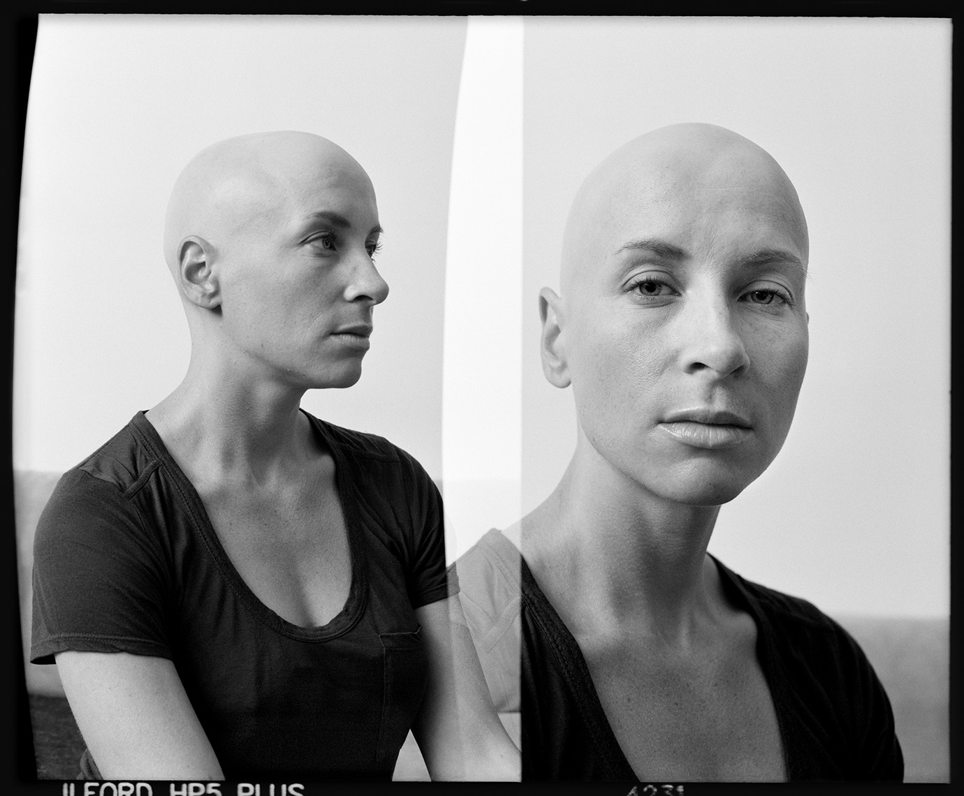 Alopecia Diptych Portrait 14