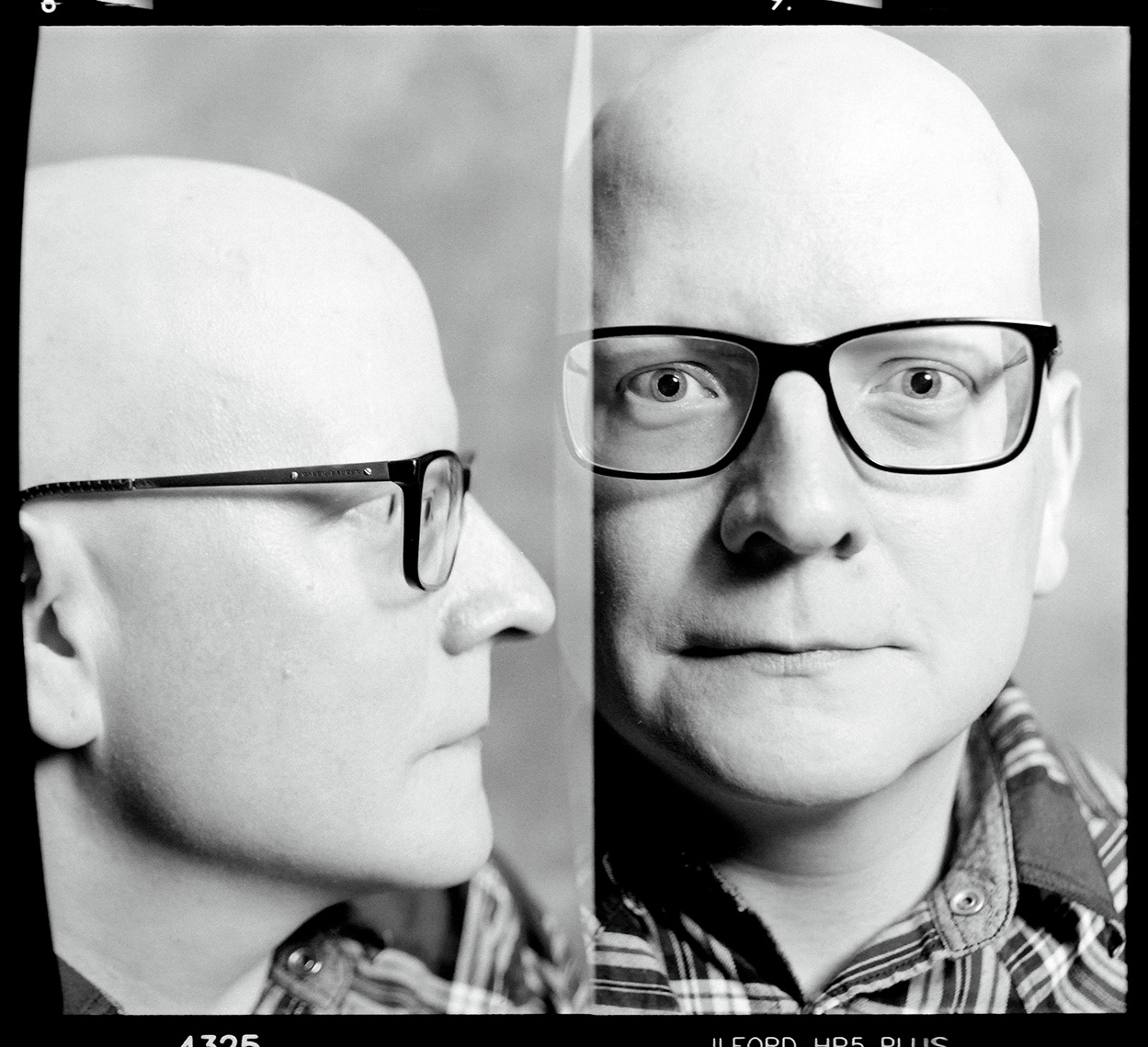 Alopecia Diptych Portrait 8