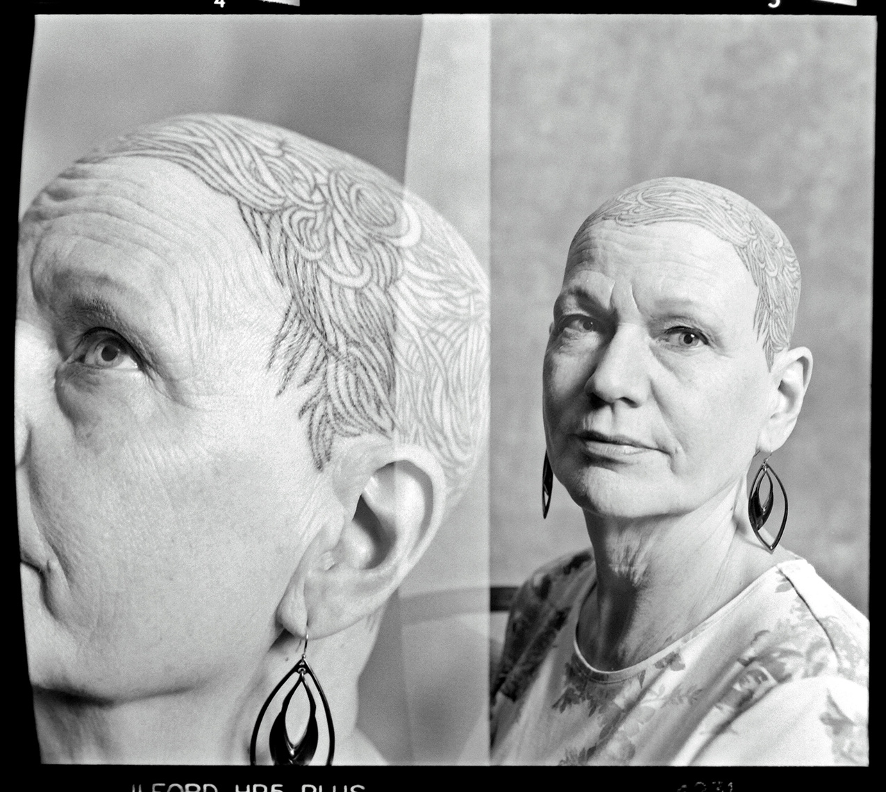 Alopecia Diptych Portrait 7