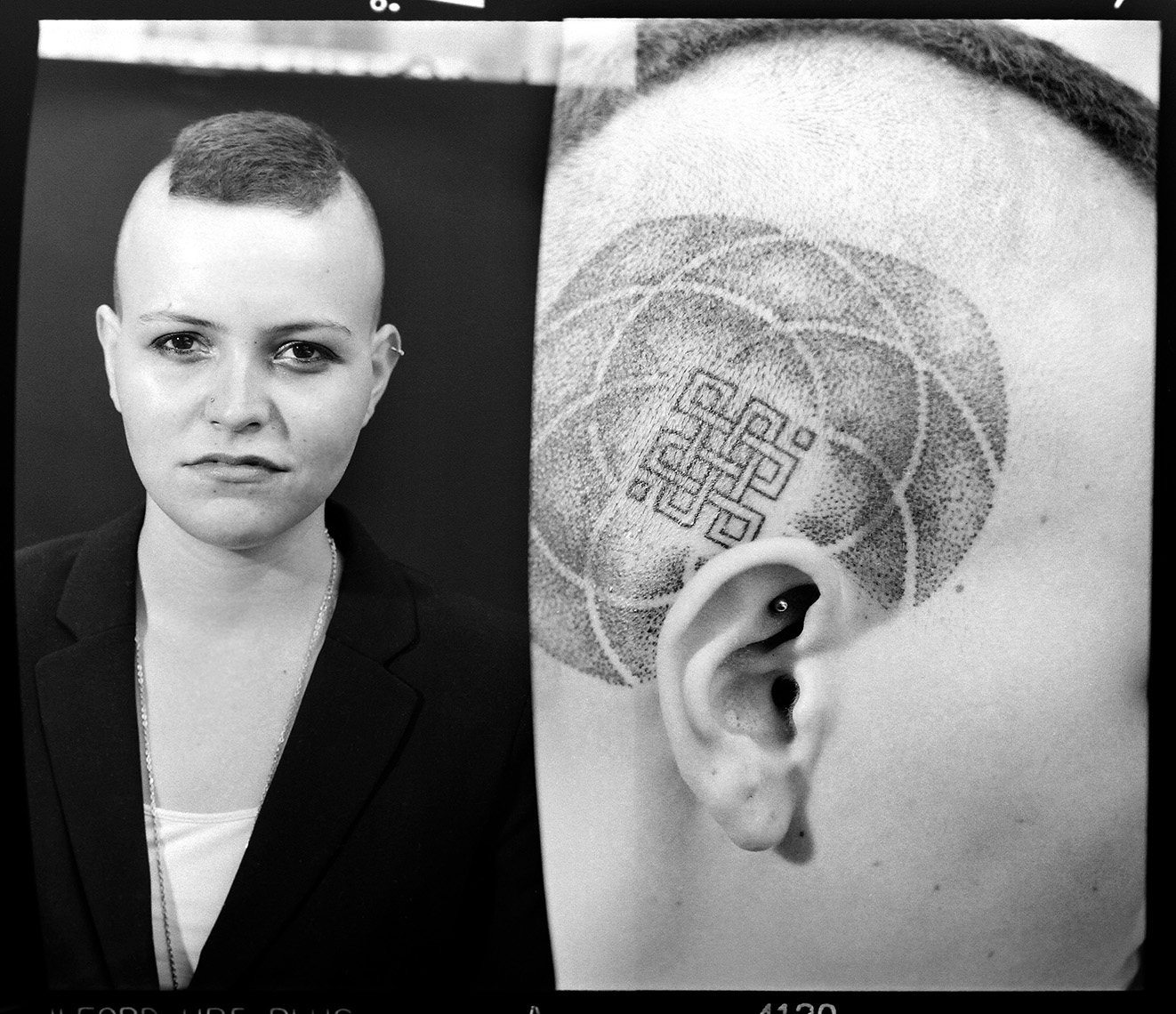 Alopecia Diptych Portrait 9