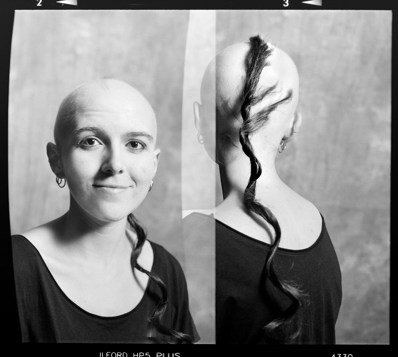 Alopecia Diptych Portrait 11