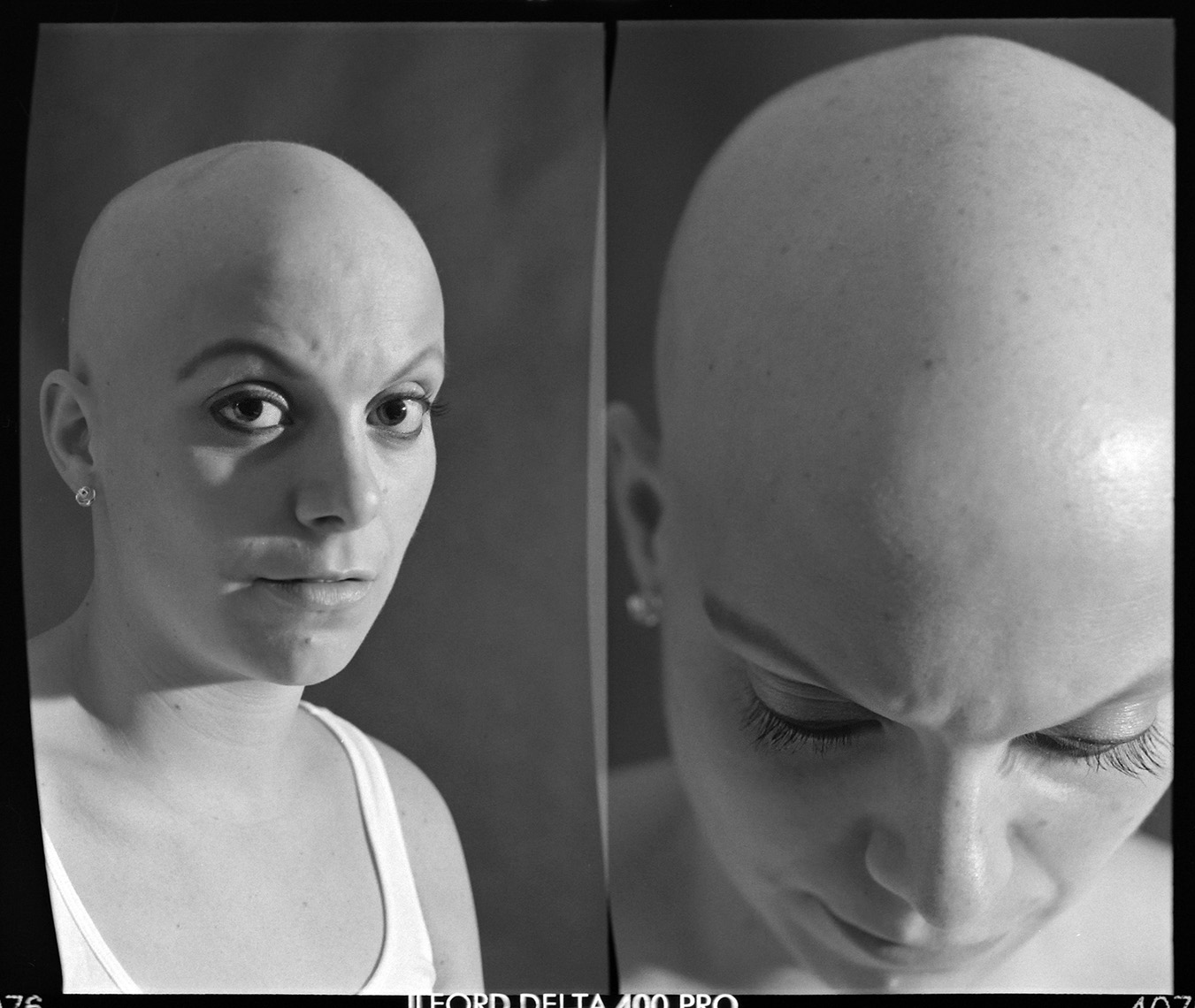 Alopecia Diptych Portrait 10