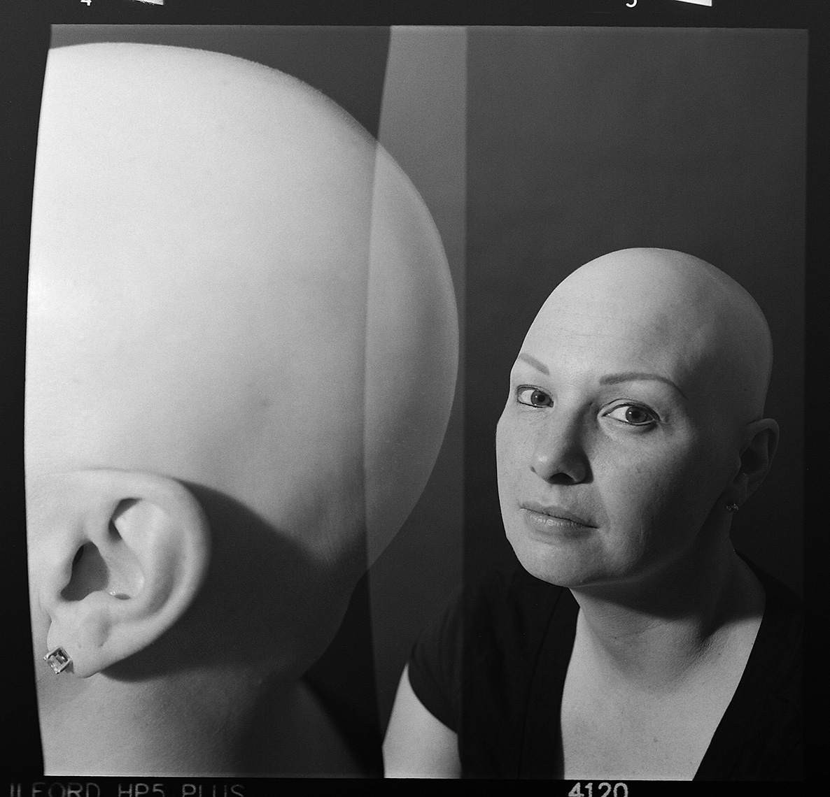Alopecia Diptych Portrait 12