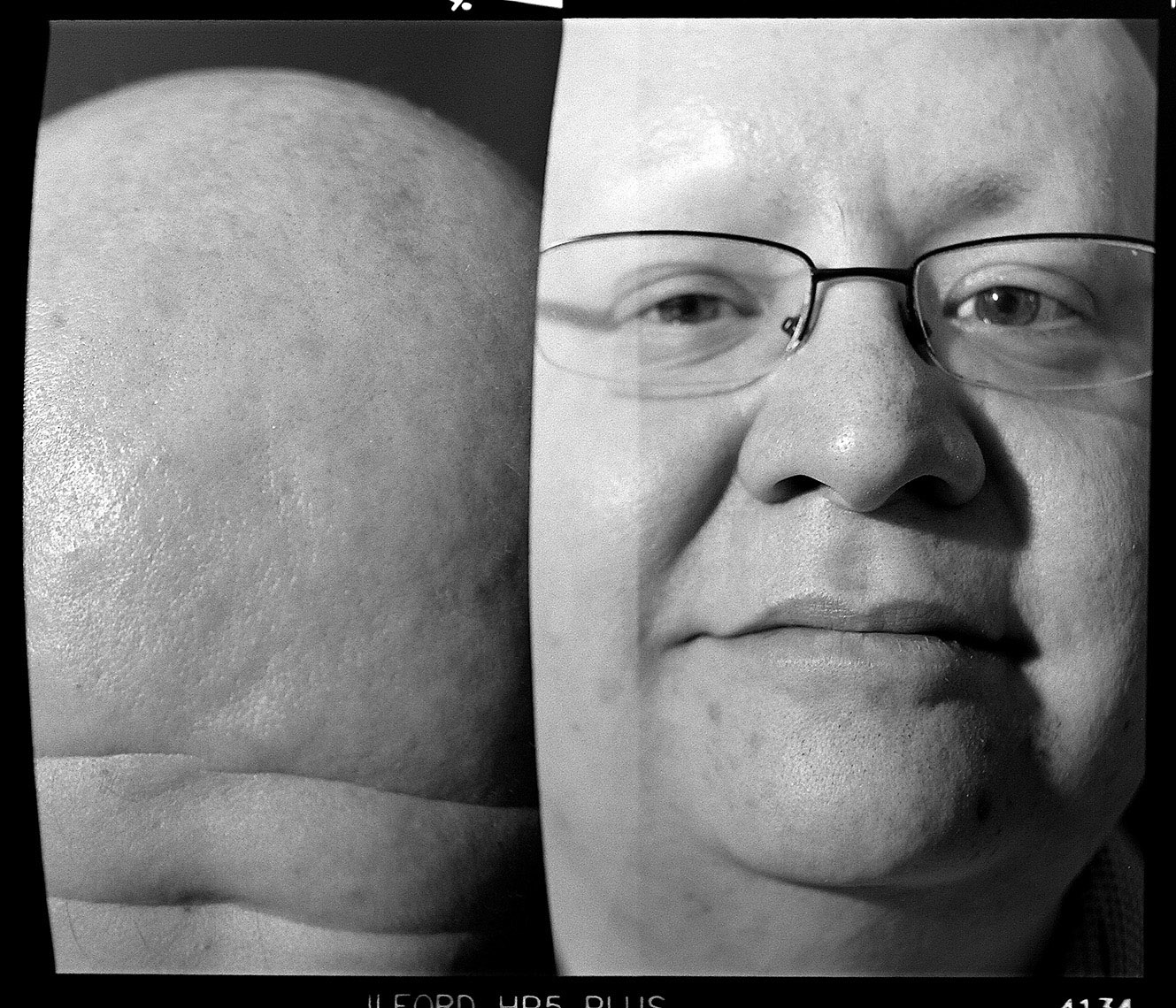 Alopecia Diptych Portrait 15