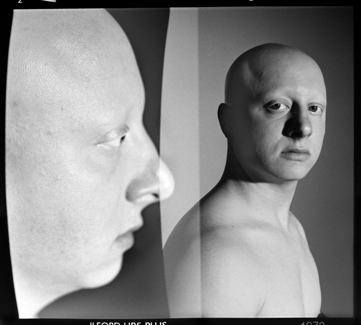 Alopecia Diptych Portrait 3