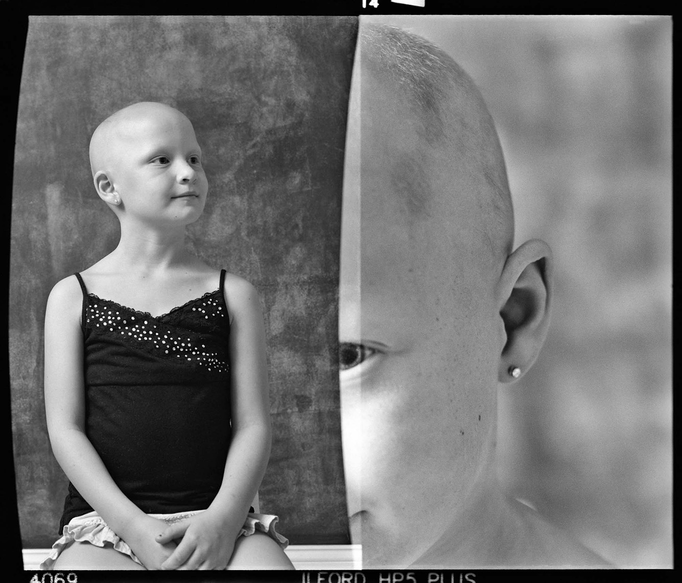 Alopecia Diptych Portrait 16